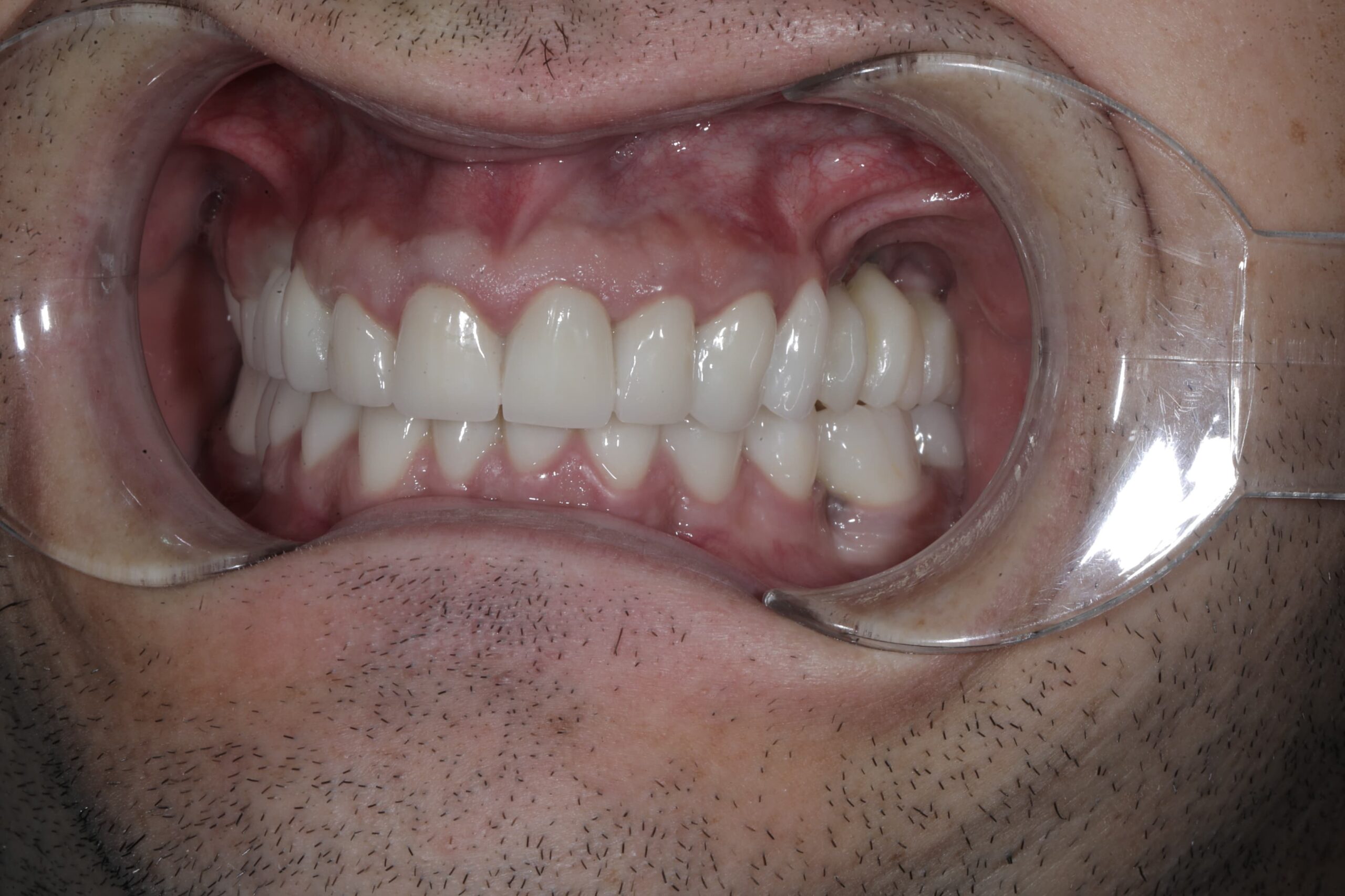 Full-mouth rehabilitation with zirconia and E.max crowns — photograph 2 of 6