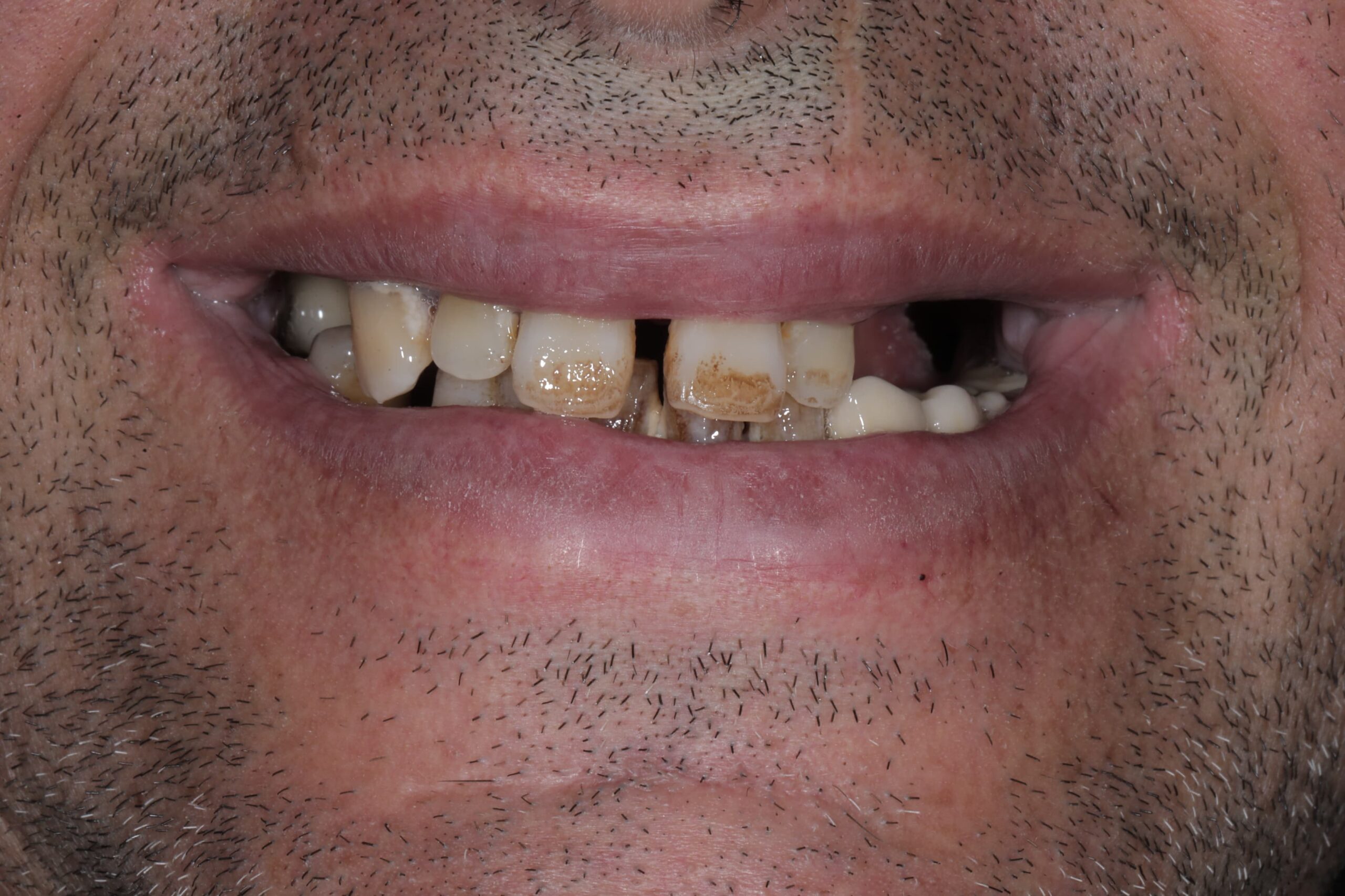 Full-mouth implant rehabilitation with zirconia bridges — photograph 2 of 6