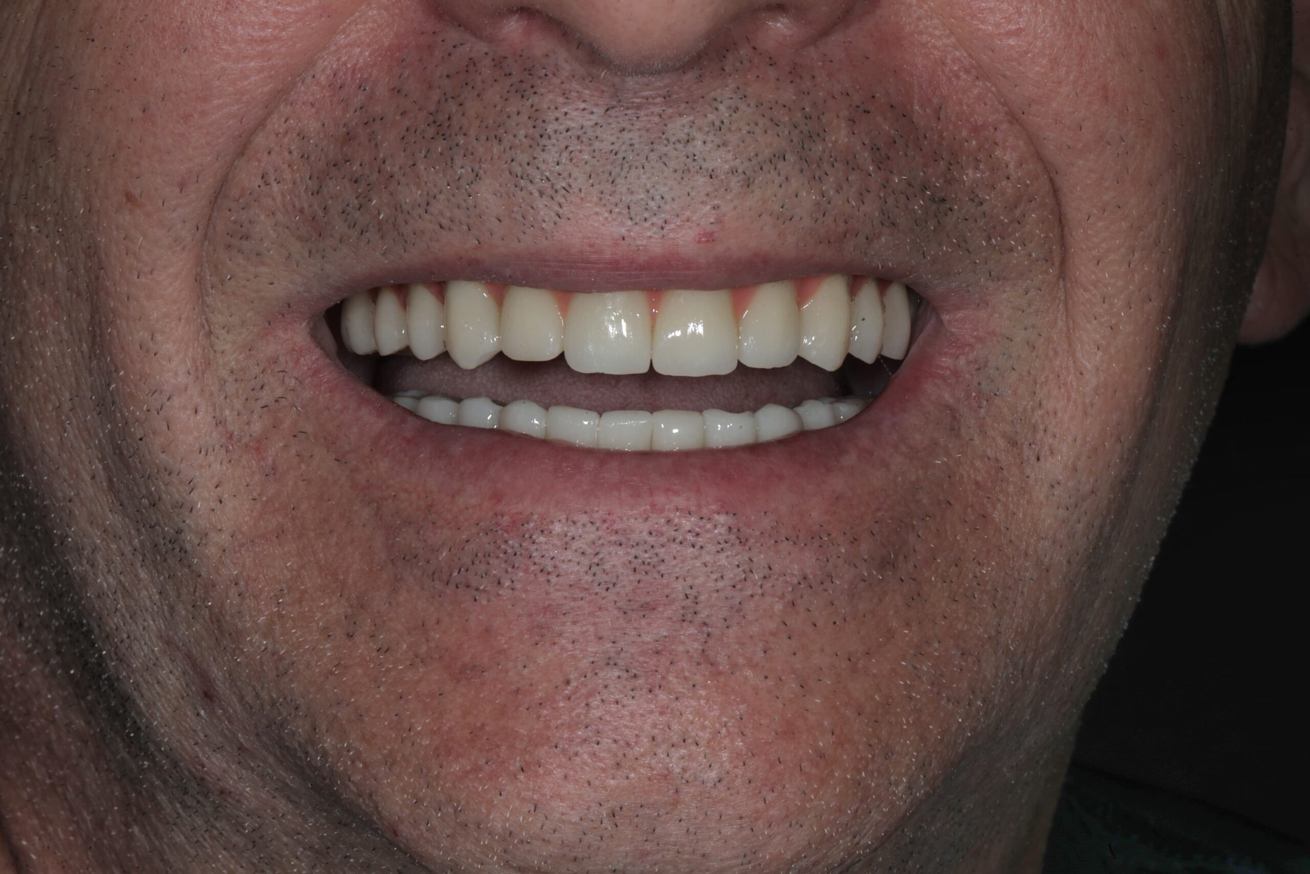 All-on-6, upper arch — advanced periodontal disease — photograph 2 of 6