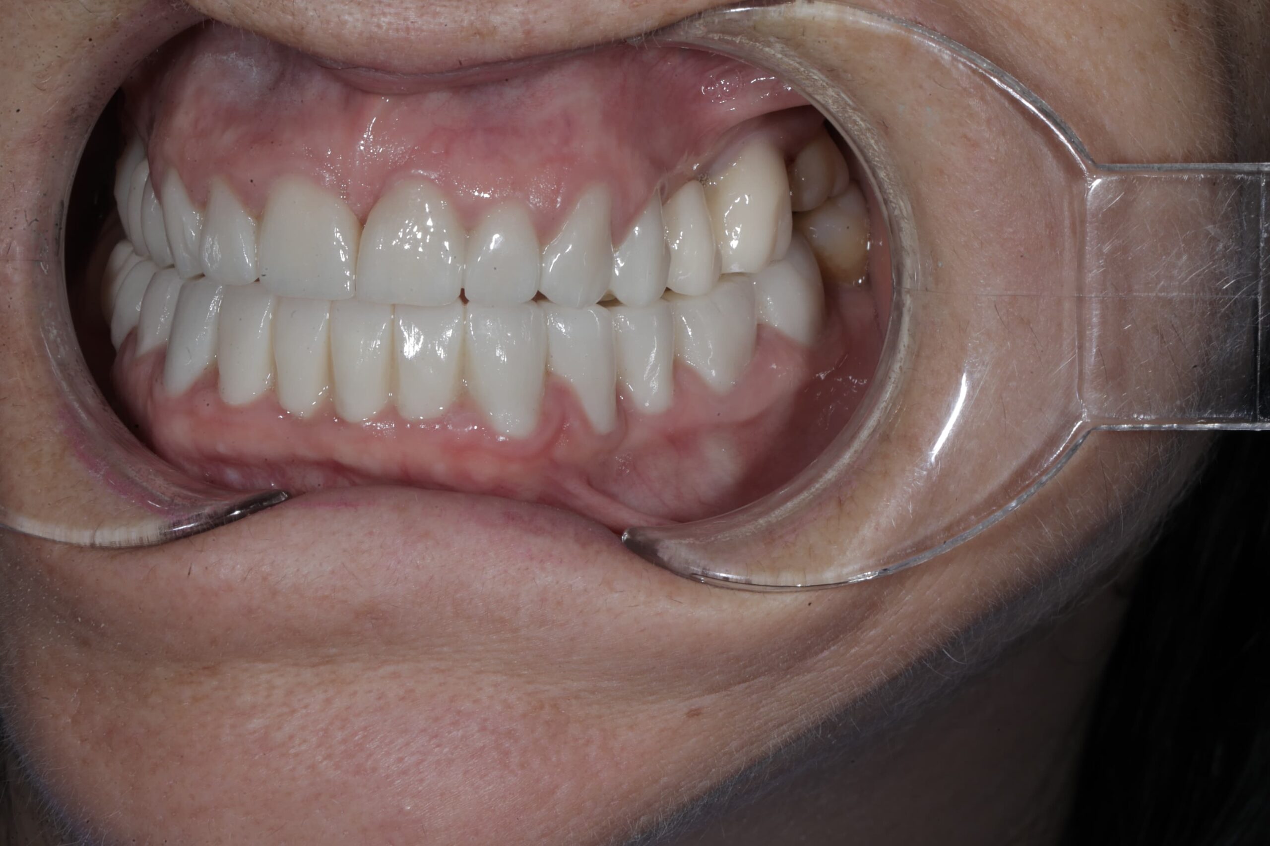 Closing gaps with full zirconia crowns — photograph 2 of 5