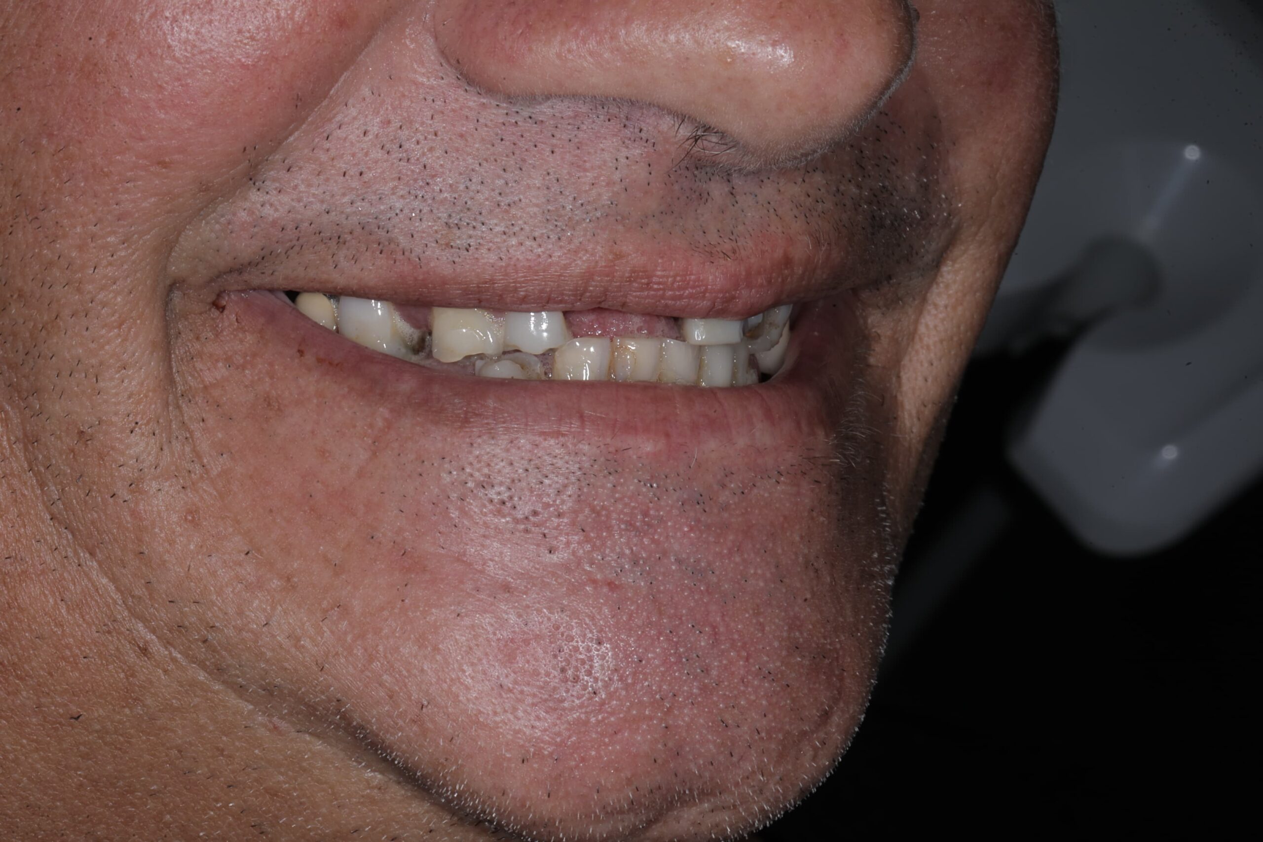 All-on-4, both arches — full mouth restoration — photograph 2 of 5