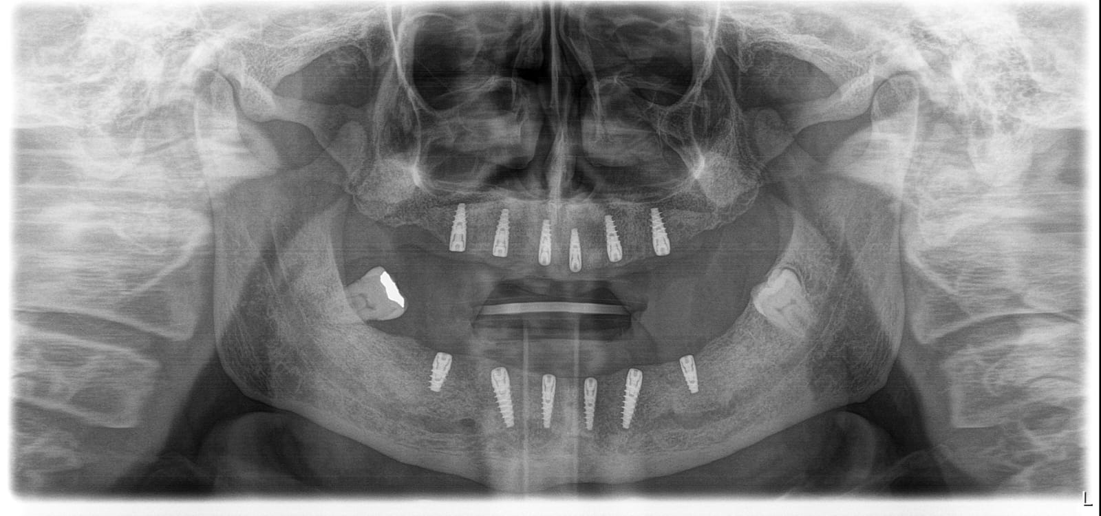 Comprehensive smile rehabilitation with implants and crowns — photograph 2 of 6