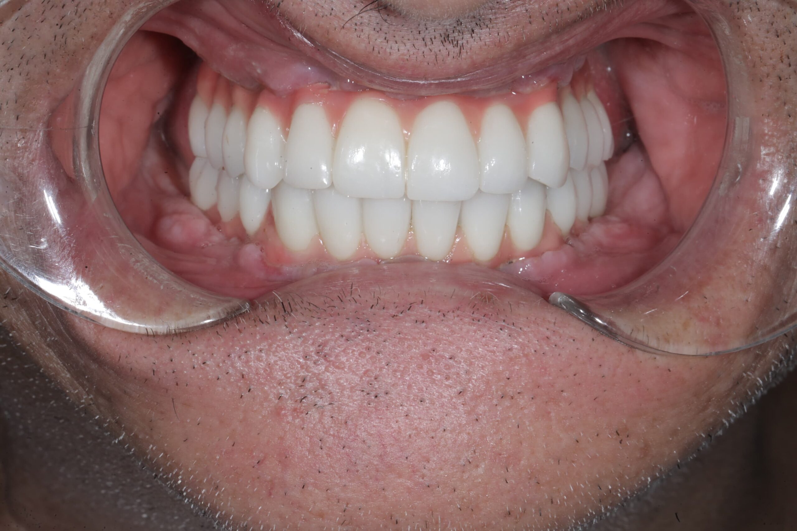 All-on-4, both arches — full mouth restoration — photograph 3 of 5