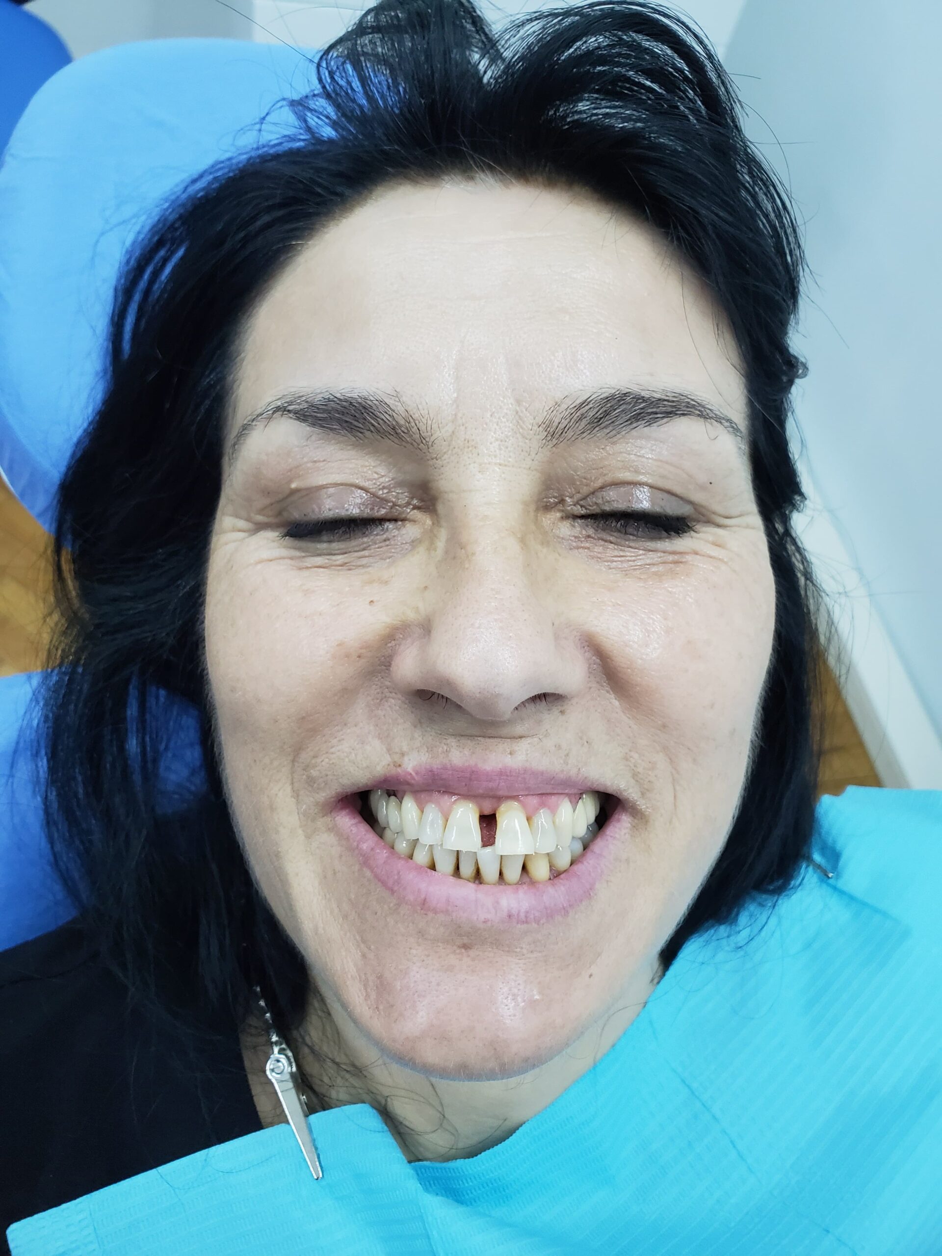 Closing gaps with full zirconia crowns — photograph 3 of 5
