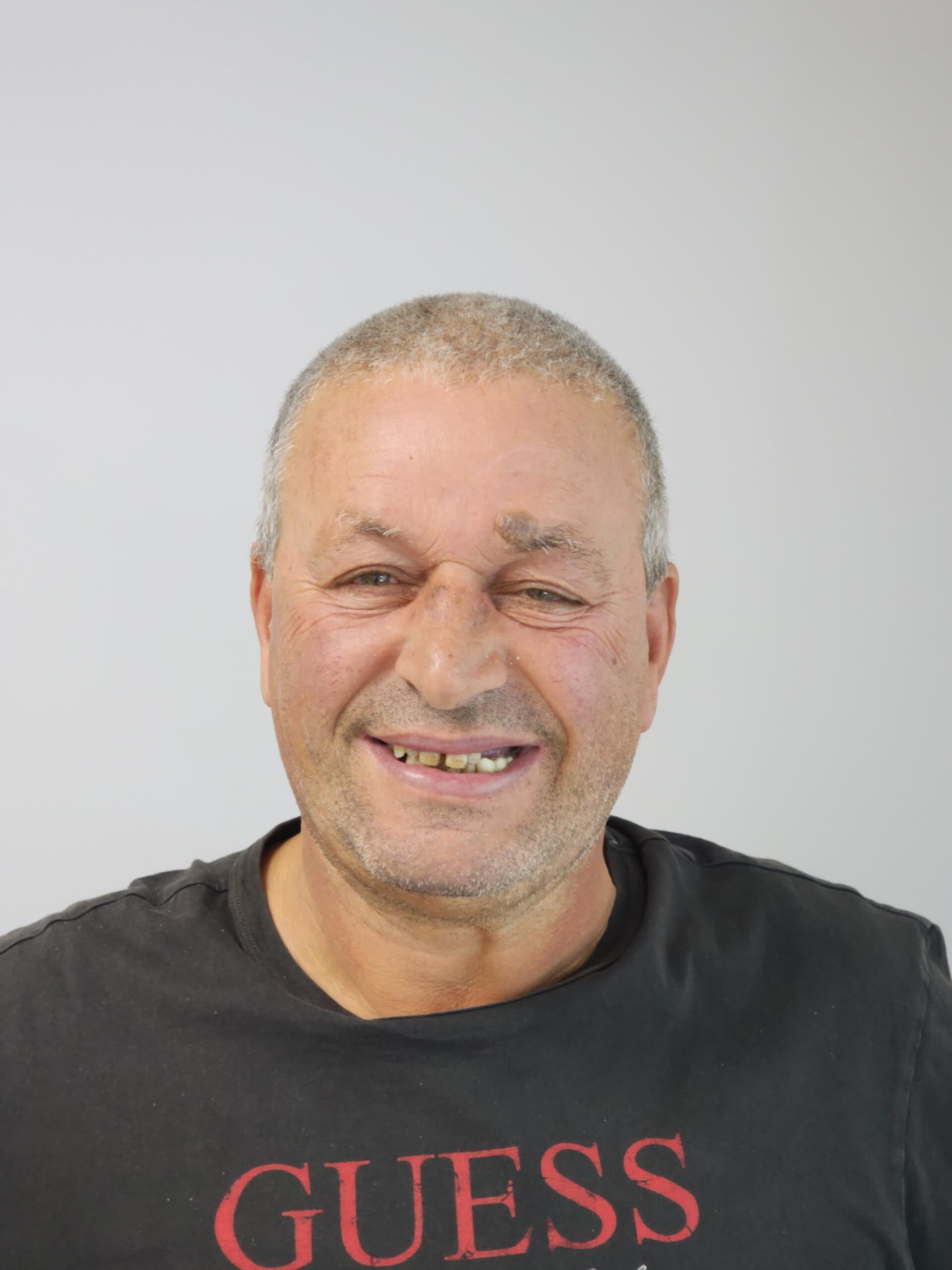 Full-mouth implant rehabilitation with zirconia bridges — photograph 3 of 6