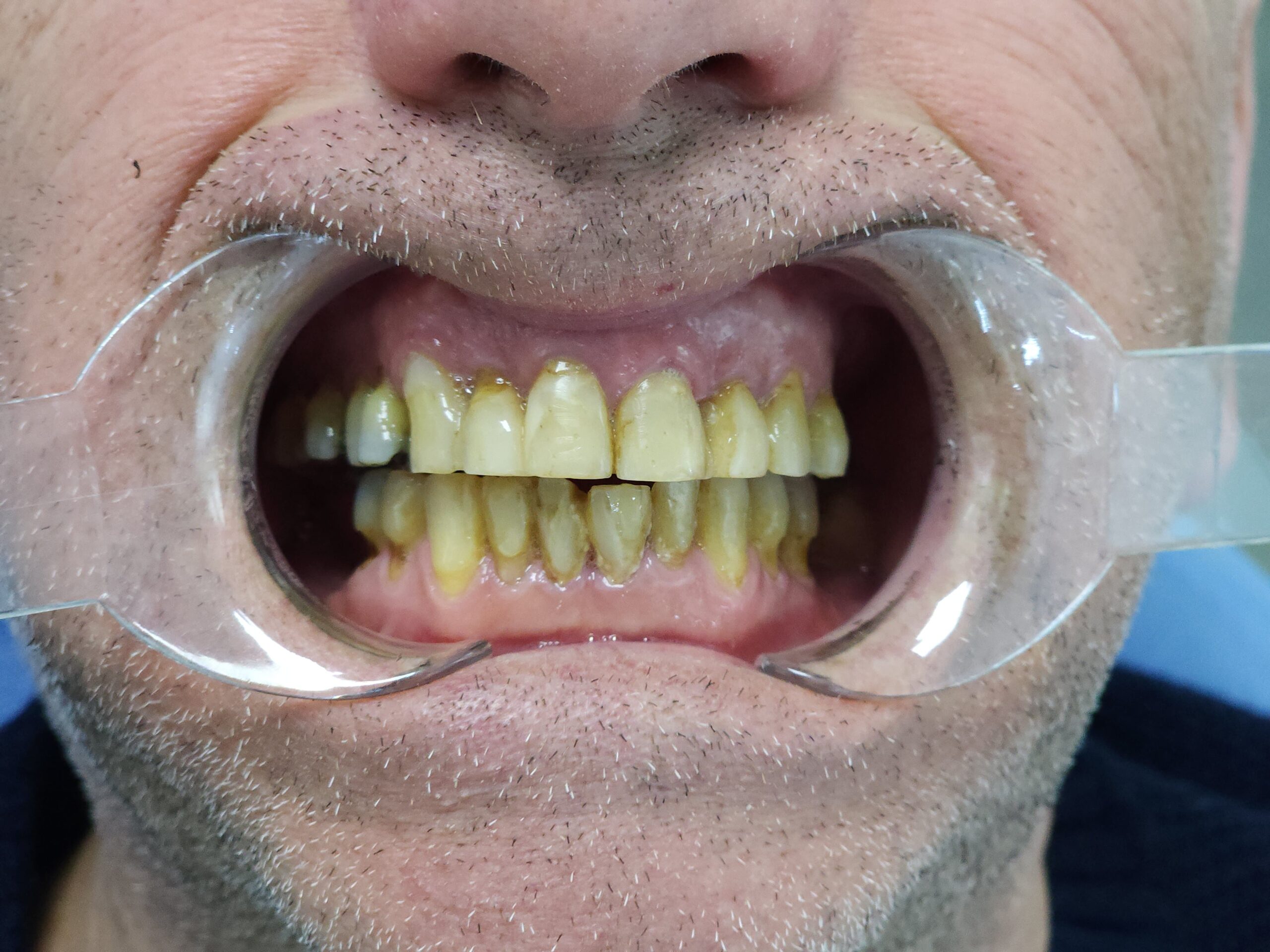 All-on-6, upper arch — advanced periodontal disease — photograph 4 of 6