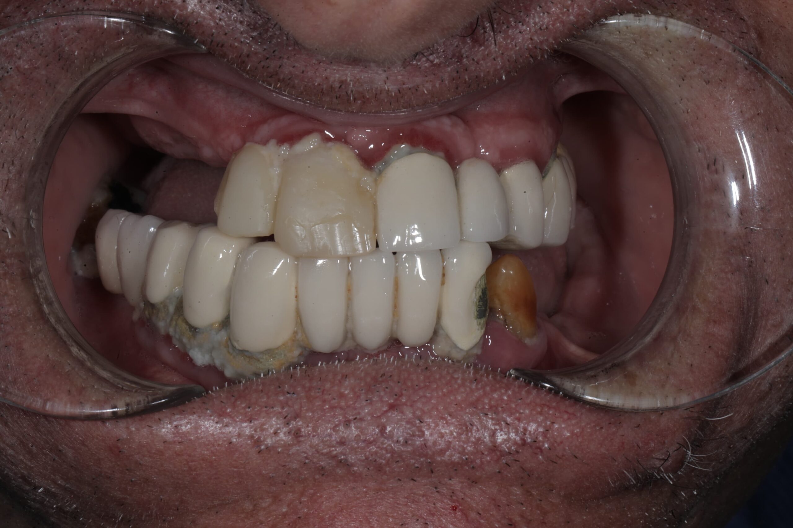 Comprehensive smile rehabilitation with implants and crowns — photograph 4 of 6