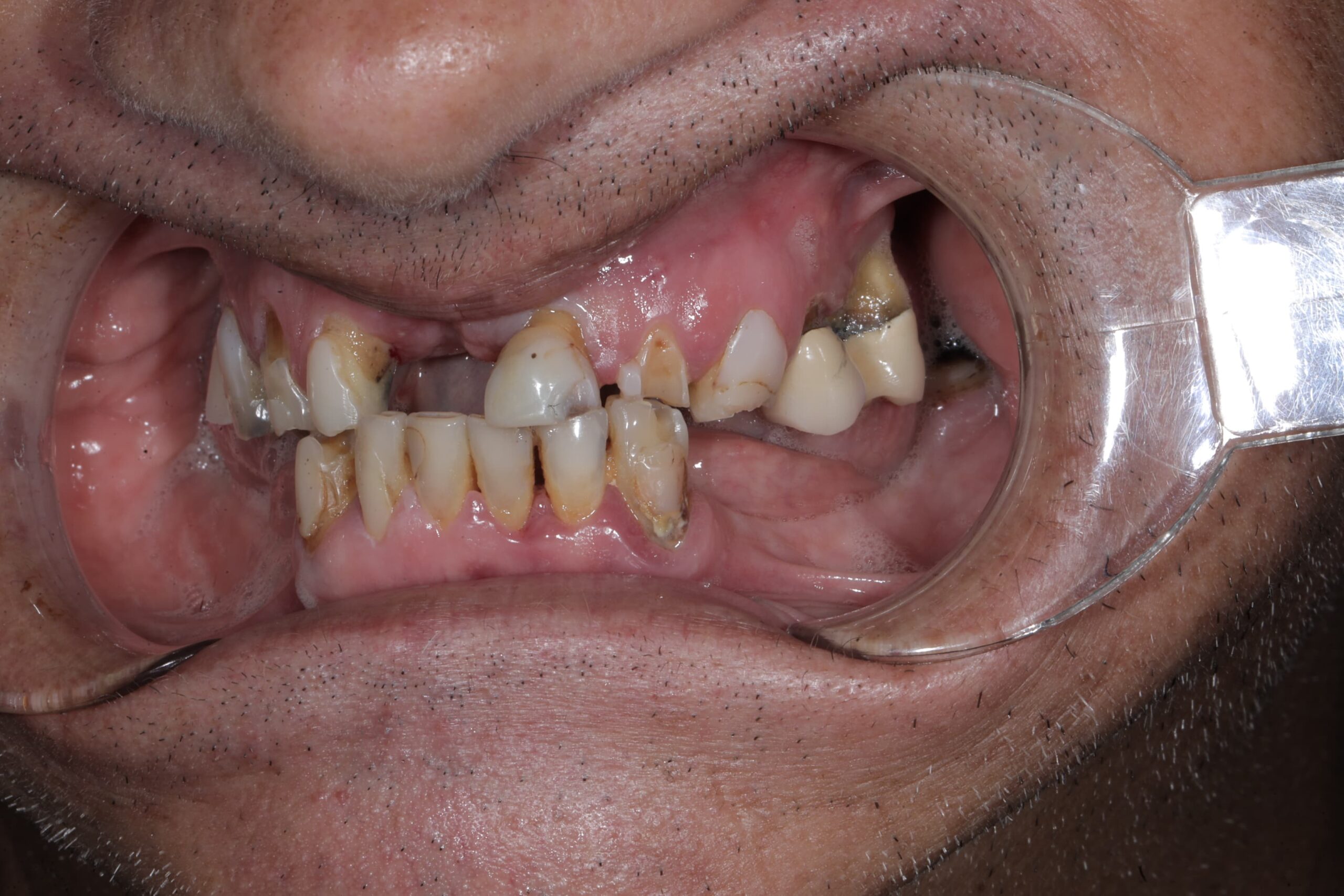 All-on-4, both arches — full mouth restoration — photograph 4 of 5