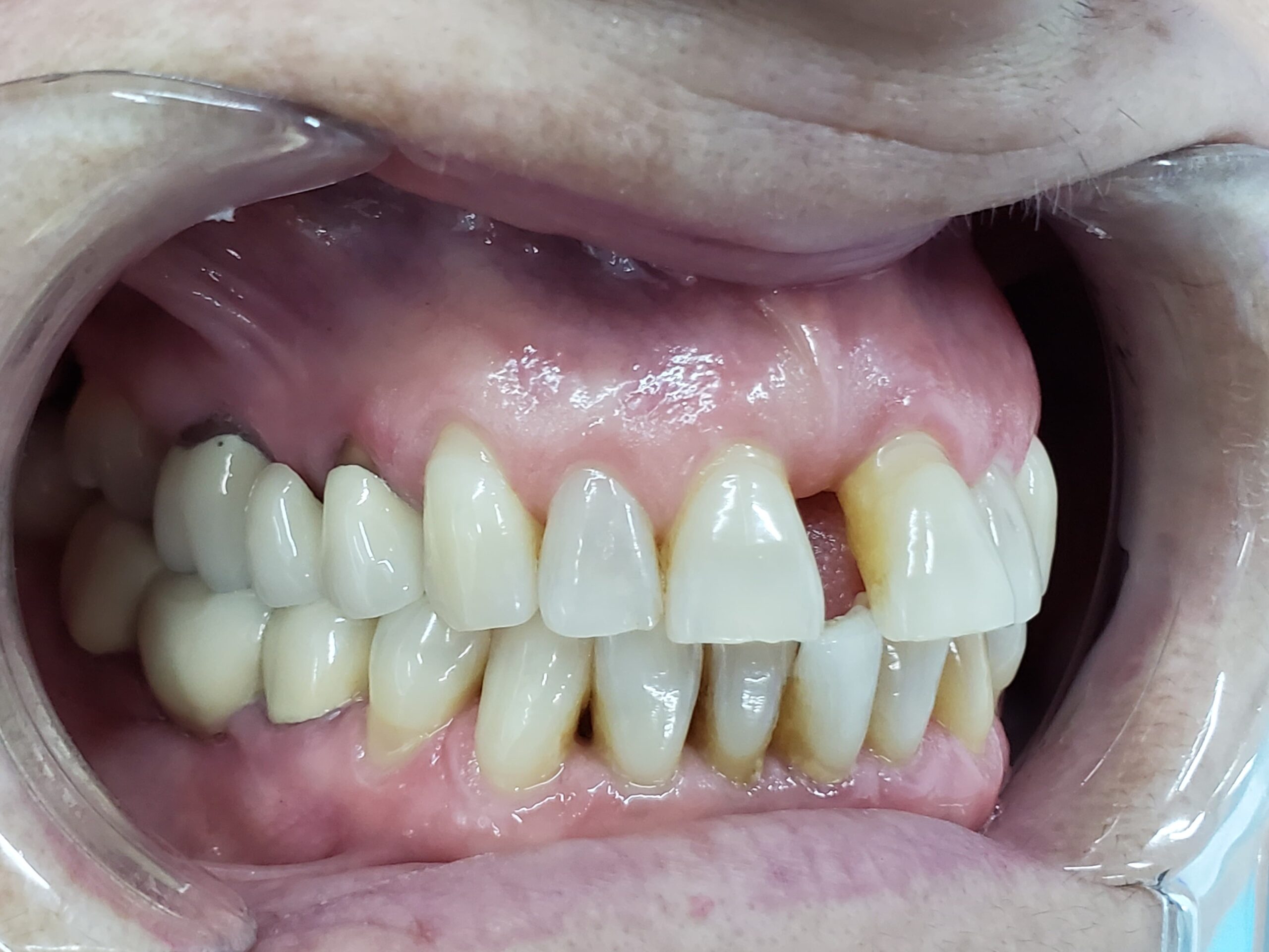 Closing gaps with full zirconia crowns — photograph 4 of 5