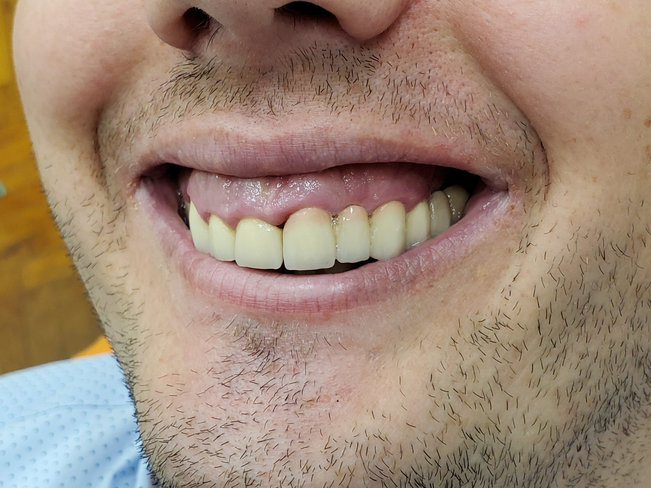 Full-mouth rehabilitation with zirconia and E.max crowns — photograph 4 of 6