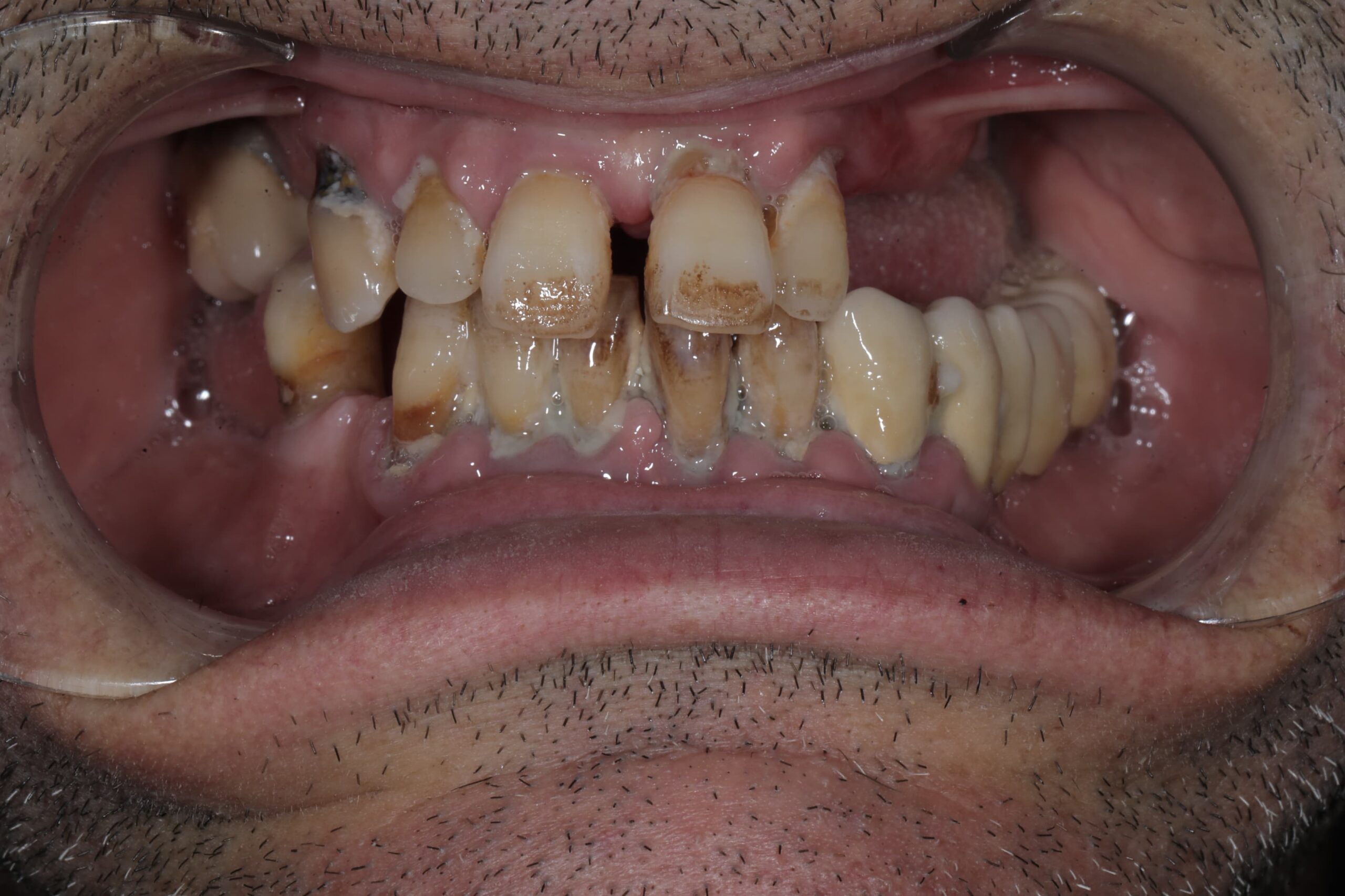 Full-mouth implant rehabilitation with zirconia bridges — photograph 4 of 6