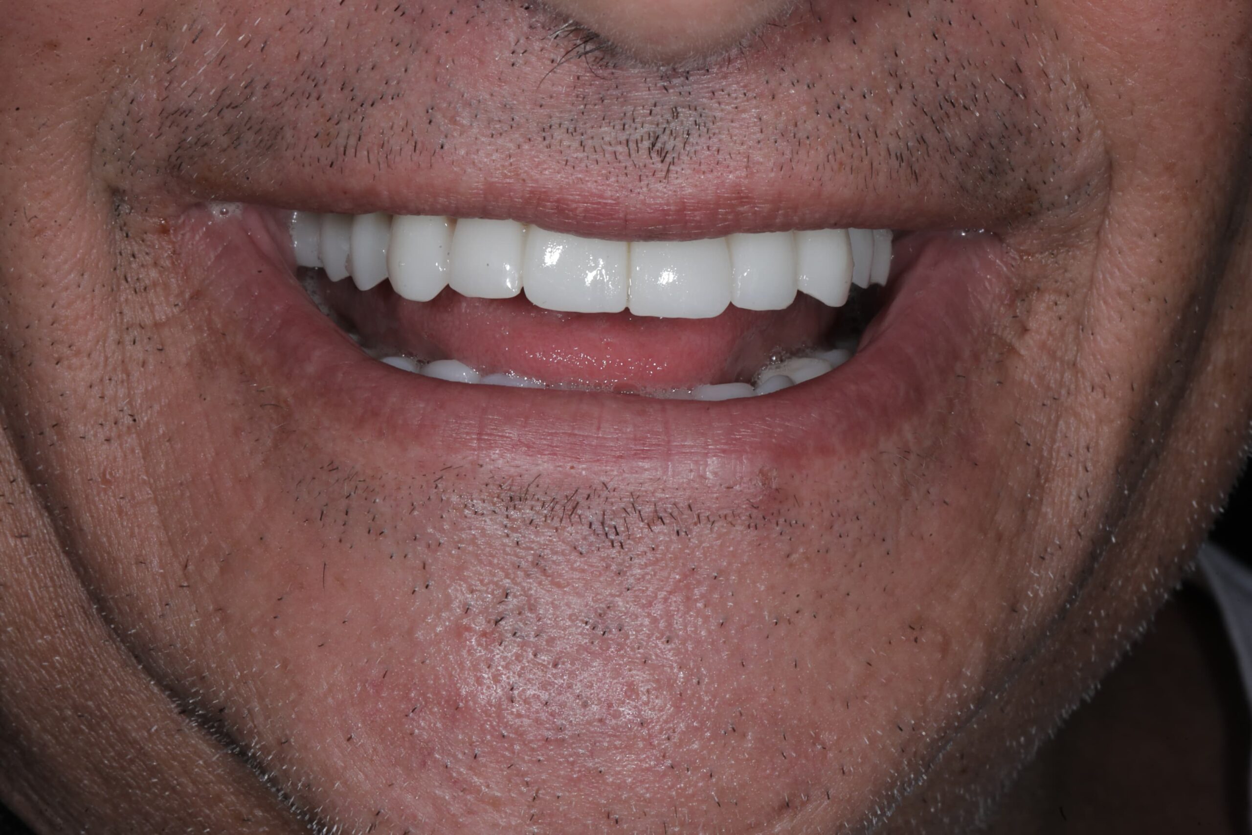 All-on-4, both arches — full mouth restoration — photograph 5 of 5