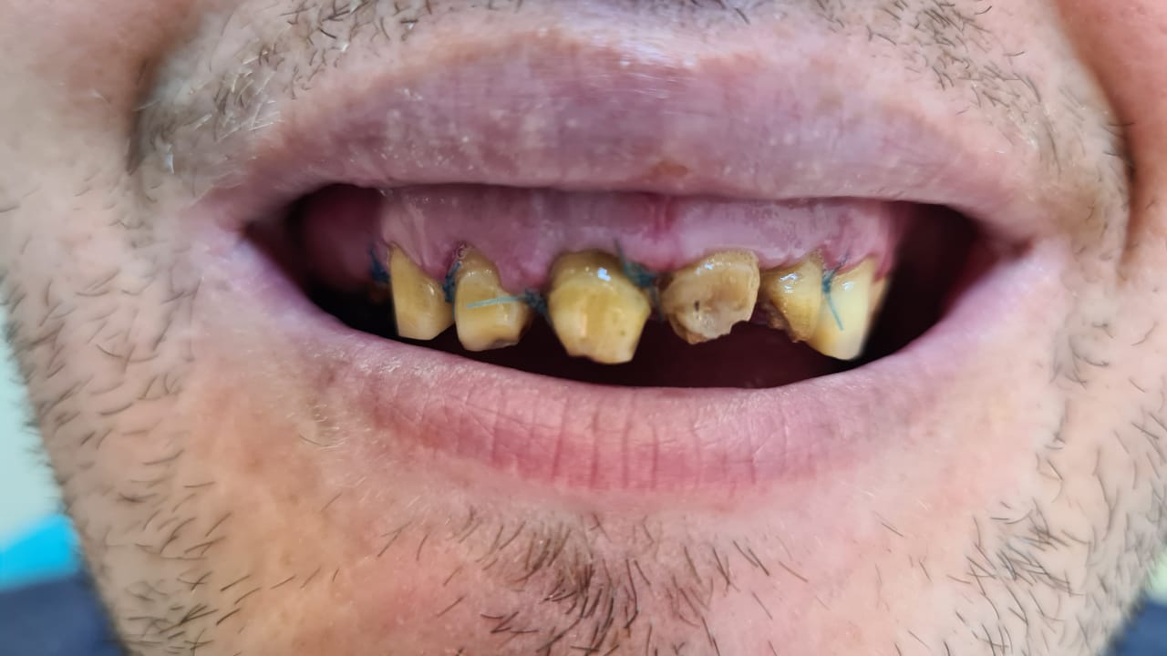 Full-mouth rehabilitation with zirconia and E.max crowns — photograph 5 of 6