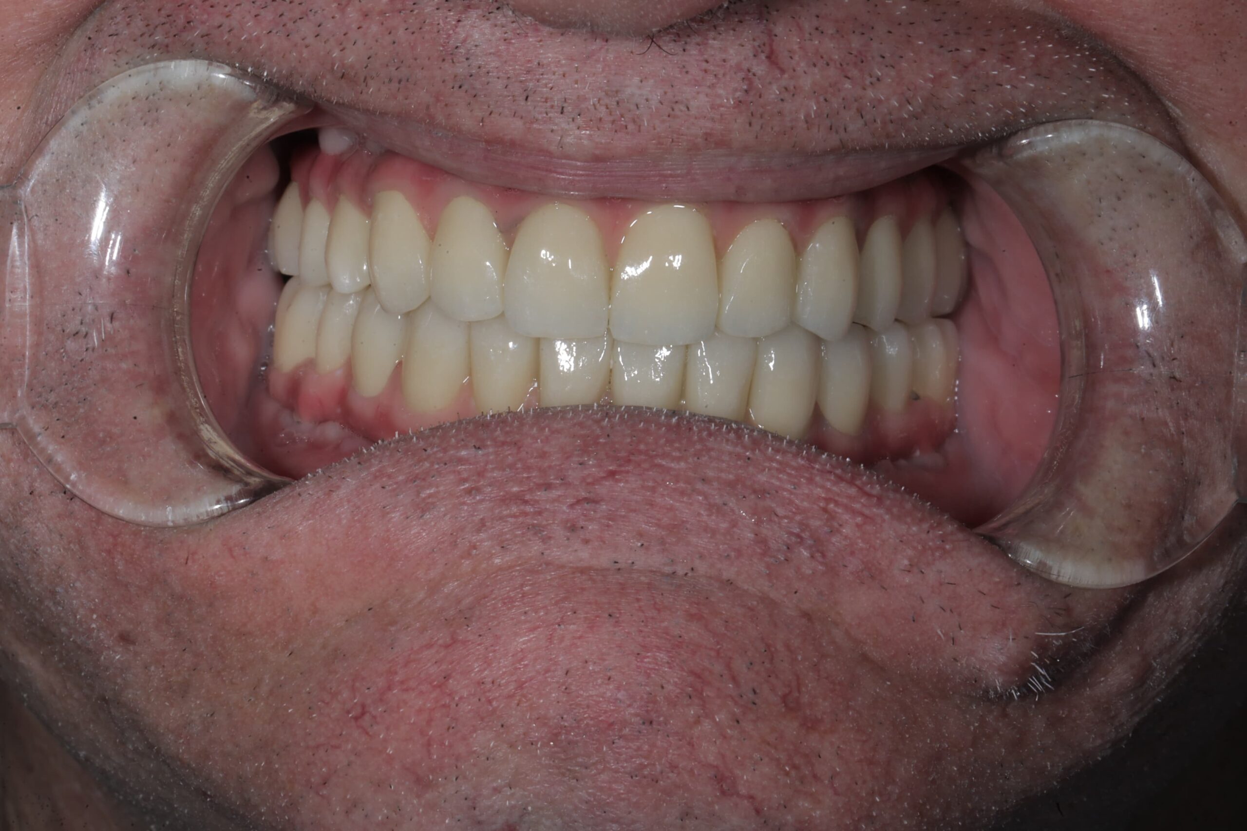 Comprehensive smile rehabilitation with implants and crowns — photograph 5 of 6