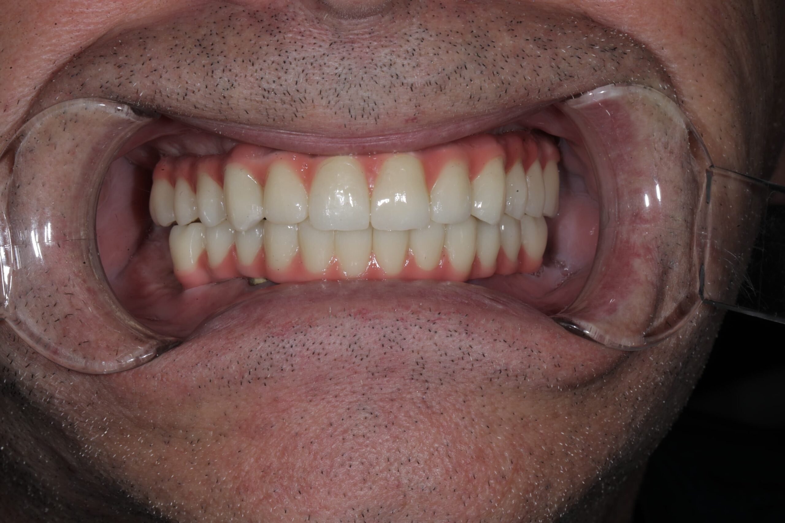 All-on-6, upper arch — advanced periodontal disease — photograph 5 of 6