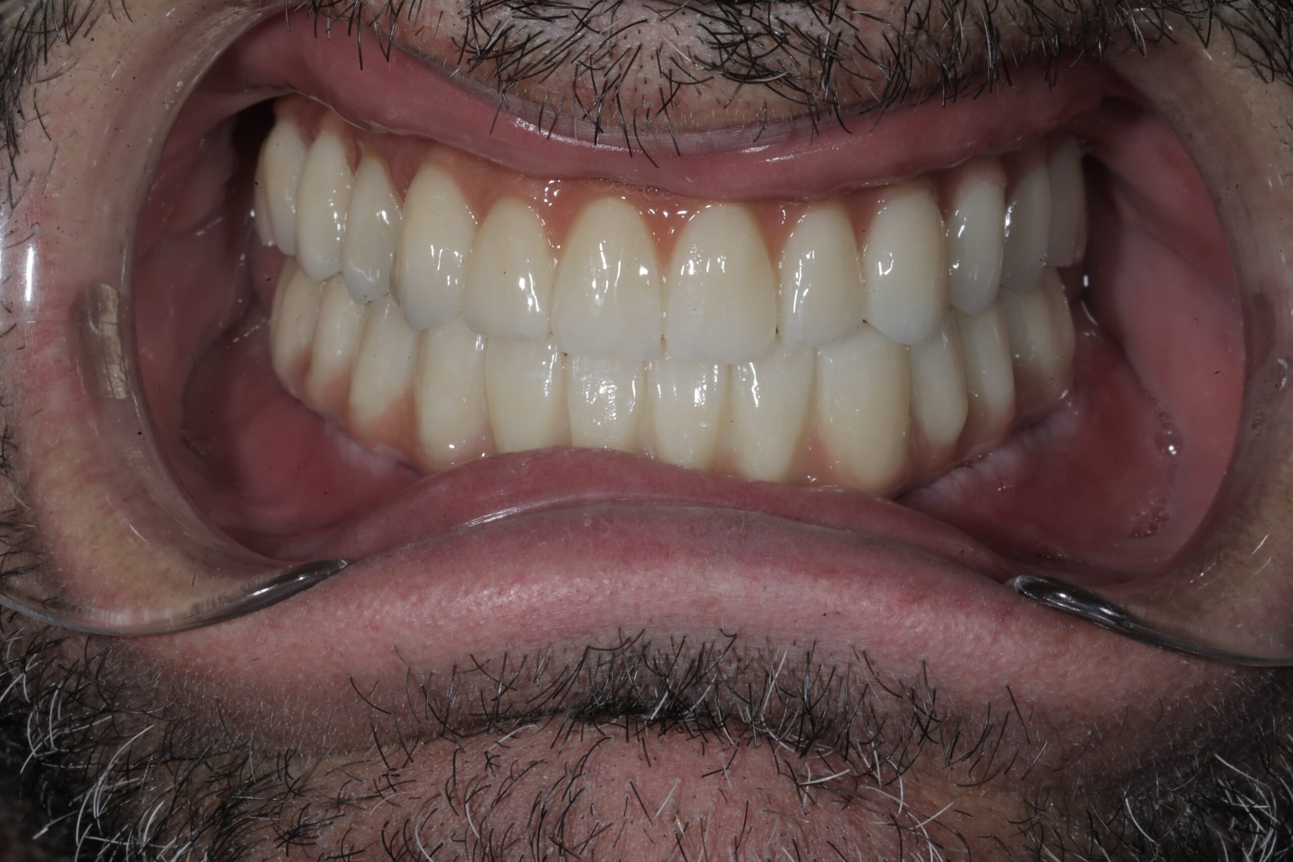 Full-mouth implant rehabilitation with zirconia bridges — photograph 5 of 6