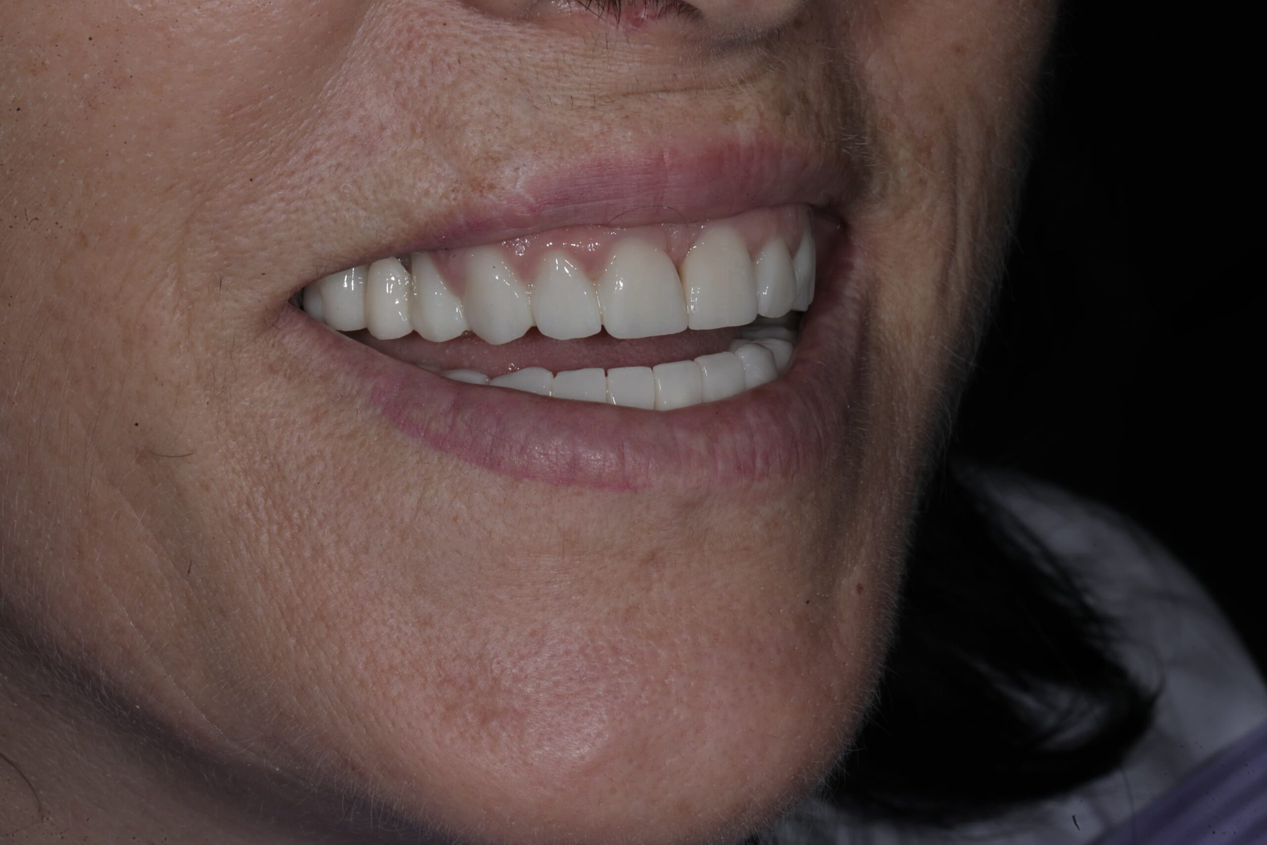 Closing gaps with full zirconia crowns — photograph 5 of 5