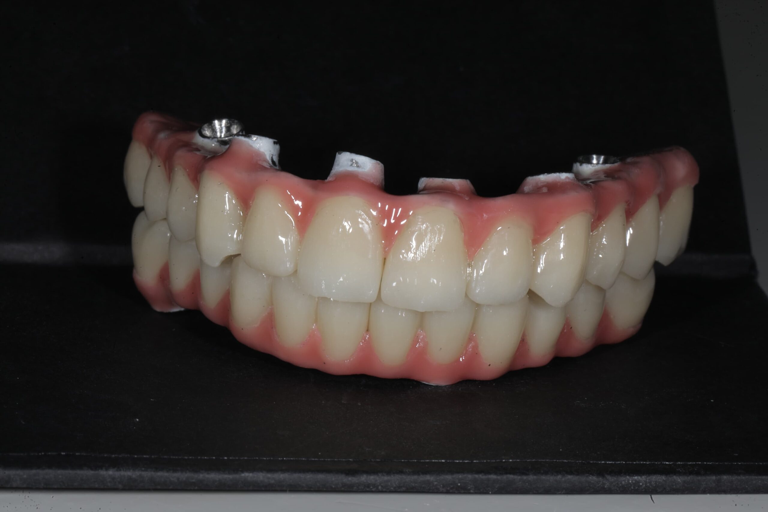 All-on-6, upper arch — advanced periodontal disease — photograph 6 of 6