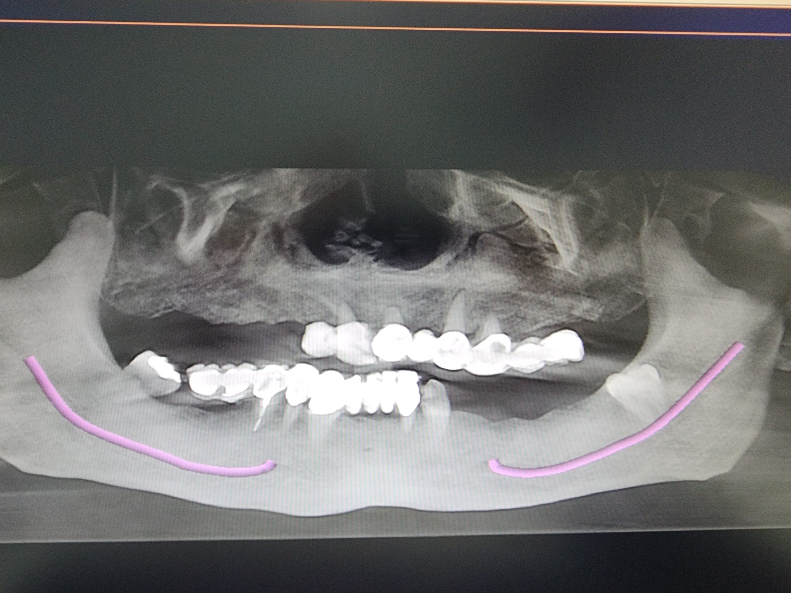 Comprehensive smile rehabilitation with implants and crowns — photograph 6 of 6