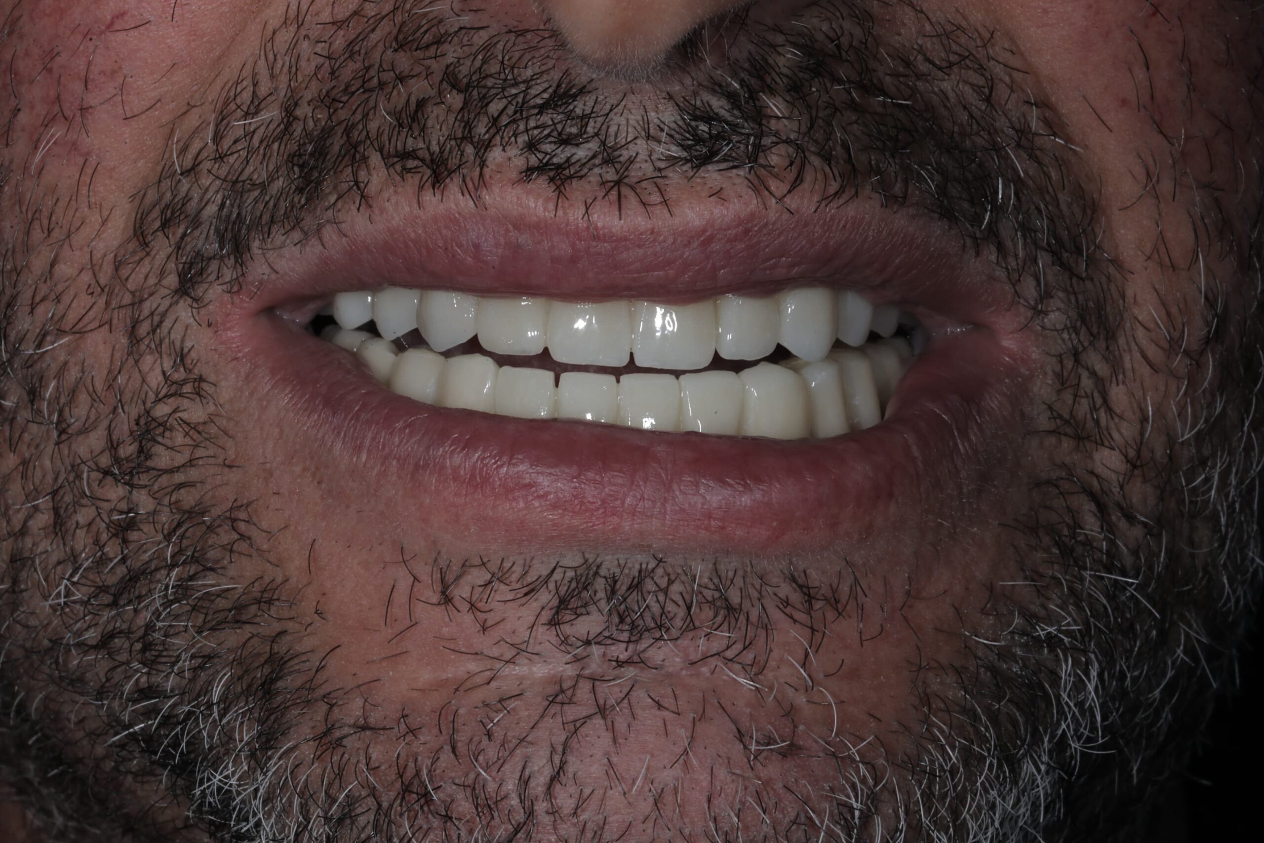 Full-mouth implant rehabilitation with zirconia bridges — photograph 6 of 6