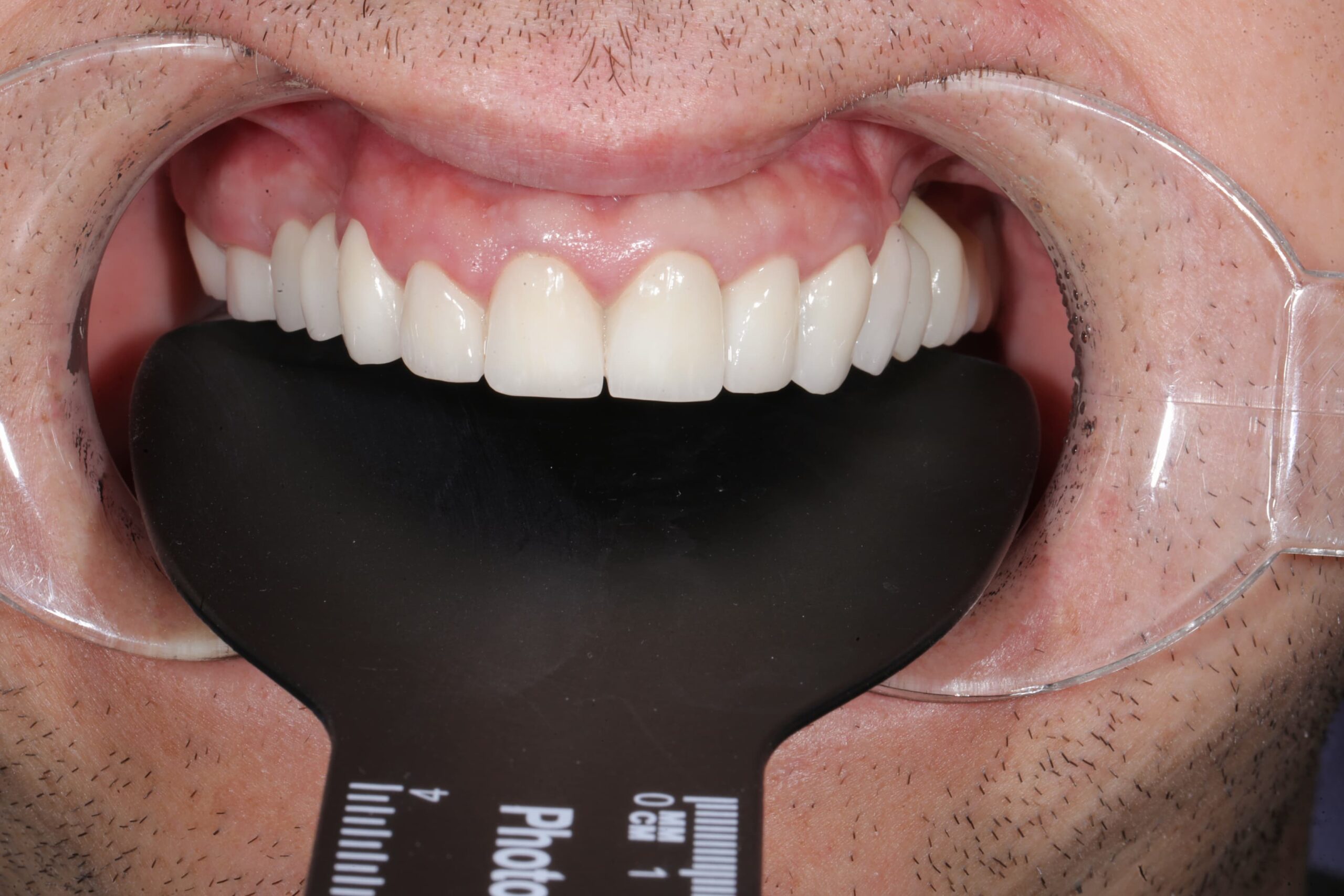 Full-mouth rehabilitation with zirconia and E.max crowns — photograph 6 of 6