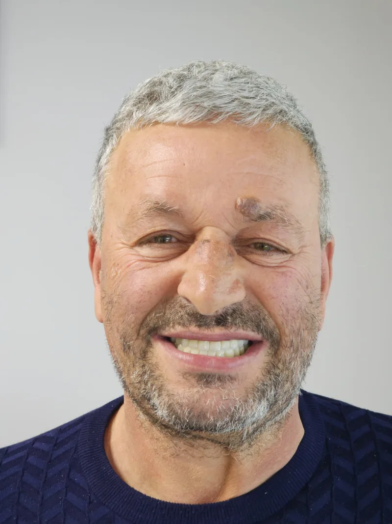 Before and after photograph — Full-mouth implant rehabilitation with zirconia bridges